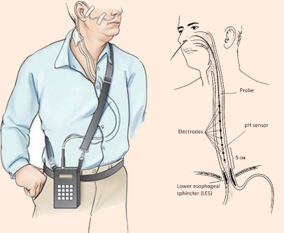Phương pháp đo pH thực quản 24 h đánh giá trào ngược